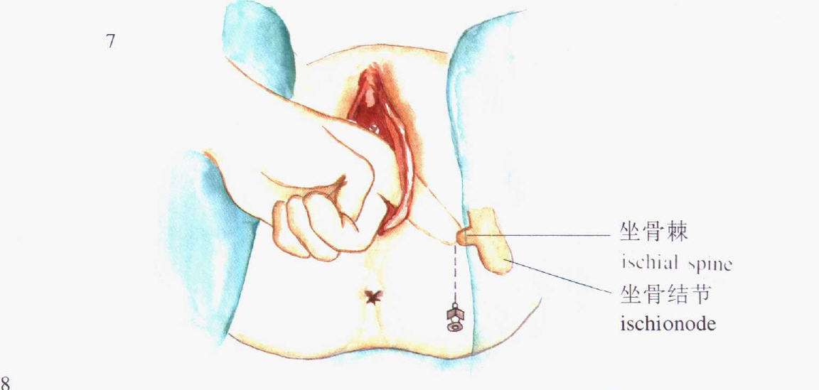 生小孩时你被“侧切”了吗？