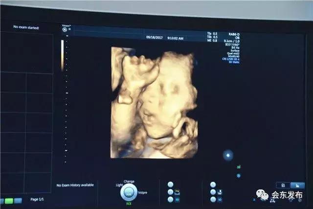 为孕妈排忧解难,现代妇婴医院四维彩超