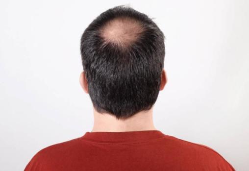 脂溢性脱发m型发际线还能恢复吗,脂溢性脱发发际线能长回来吗