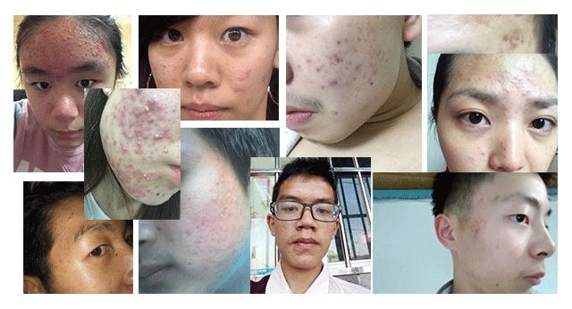 一个月解决痘痘方法,一个多月的痘痘怎么消