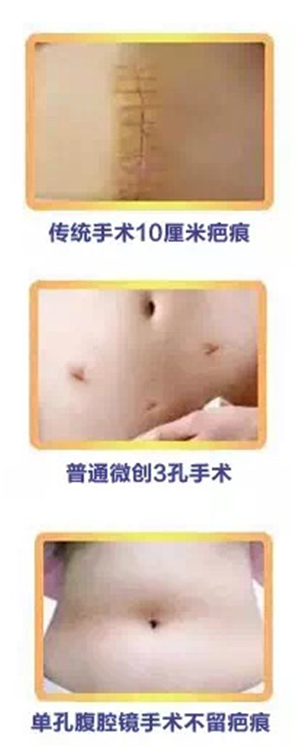 淄博妇幼宫腹腔镜,淄博市妇幼保健院腹腔镜手术