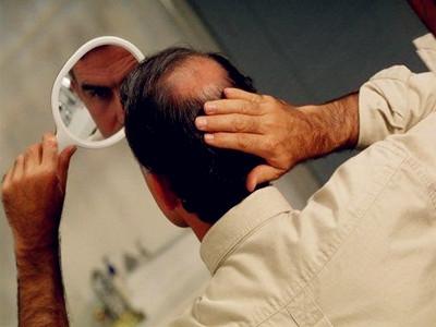 脂溢性脱发m型发际线还能恢复吗,脂溢性脱发发际线能长回来吗