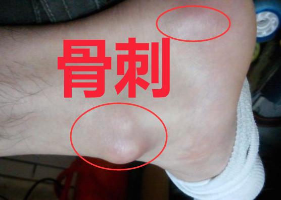 中医治疗骨刺特效方,治老年骨刺有效的膏药