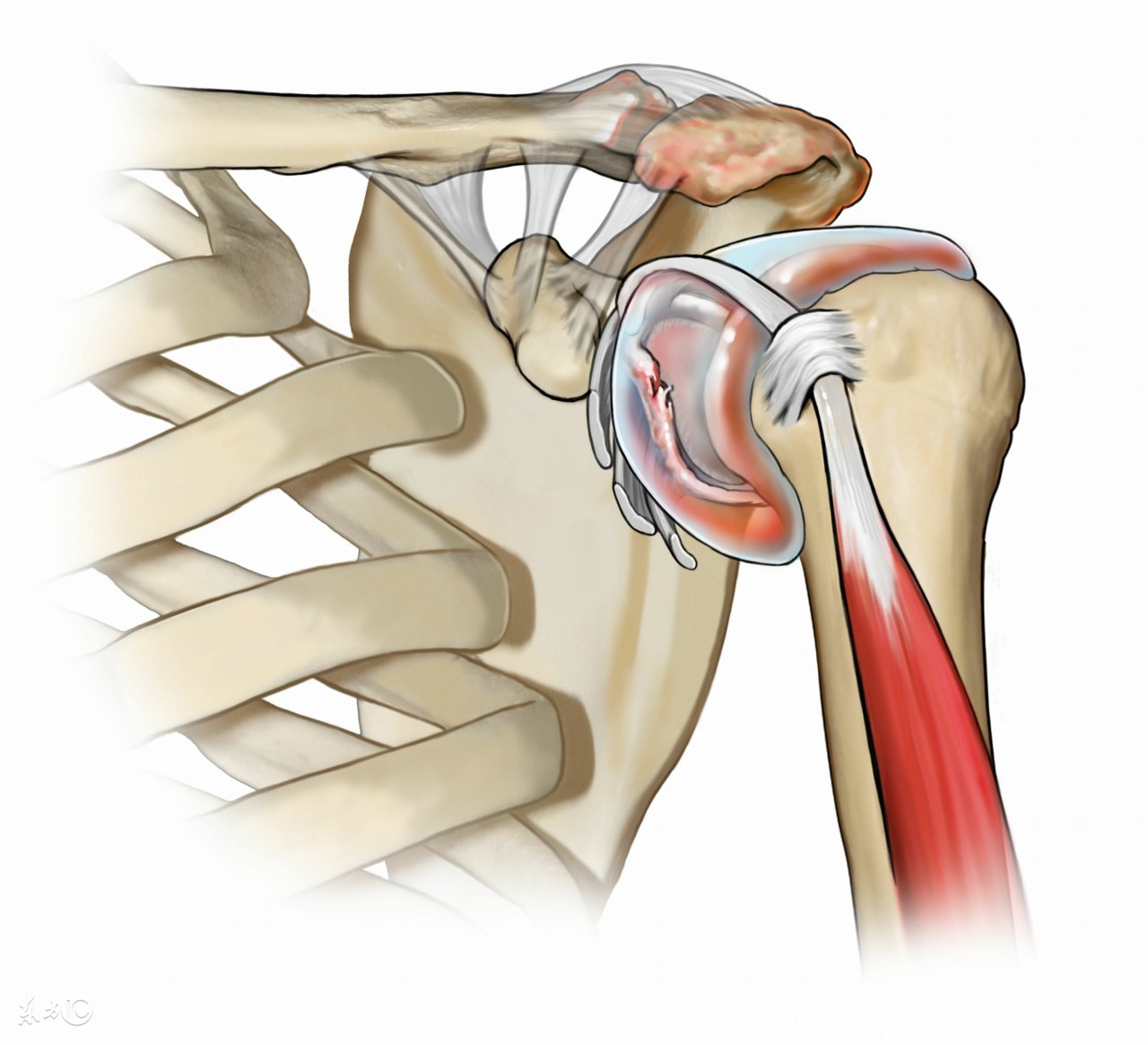 骨盆滑膜炎久治不愈,踝关节滑膜炎久治不愈怎么办