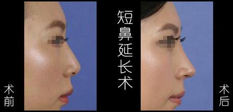 鼻子整形的方法有几种,鼻子整形能改变容貌吗