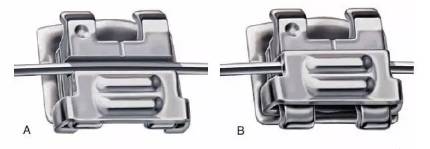 网上买透明牙套矫正牙齿靠谱吗,小孩矫正牙齿用哪种牙套比较好