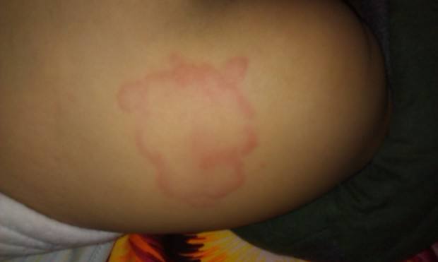 宝宝的尿布疹类型有这么多种？对症下“药”才有效！