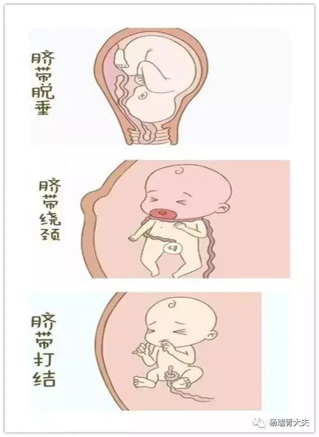 产妇突发脐带脱垂医生跪姿托举,脐带脱垂生死营救视频