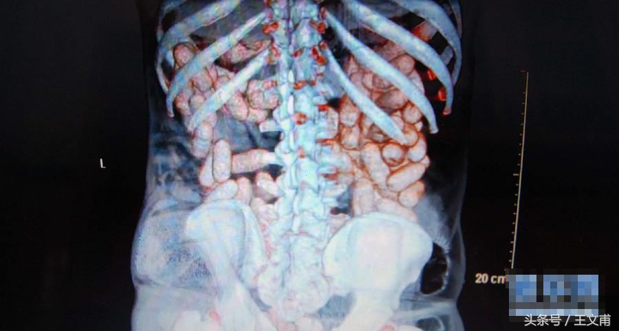 比好莱坞大片还震撼!带你识别人体藏毒的凶残手法