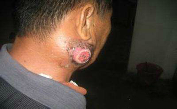 淋巴结核脓肿鼓得很严重，突然破了流脓、流水，怎么回事？