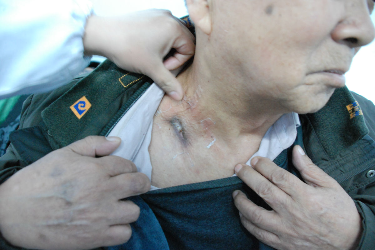 淋巴结核脓肿鼓得很严重，突然破了流脓、流水，怎么回事？