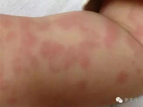 新生儿:婴儿皮肤起红疹?教你如何护理宝宝娇嫩的皮肤