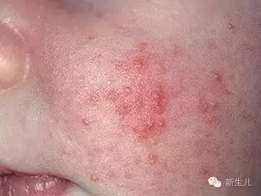 新生儿:婴儿皮肤起红疹?教你如何护理宝宝娇嫩的皮肤