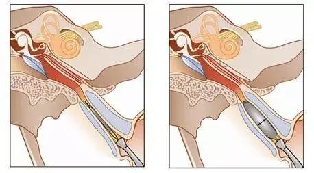 耳朵闷痛怎么回事,耳朵闷是怎么回事用什么药