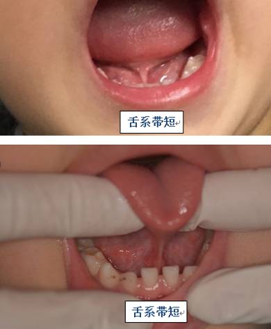 家长带孩子看舌系带,孩子舌系带短需要切除吗