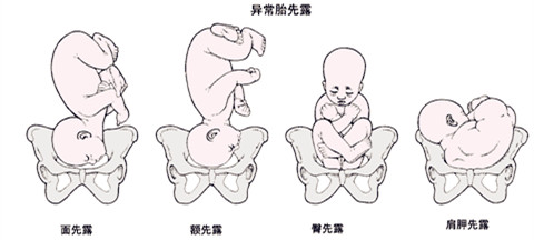 脐带脱垂的应急预案及处理流程,孕妈突发脐带脱垂了怎么办