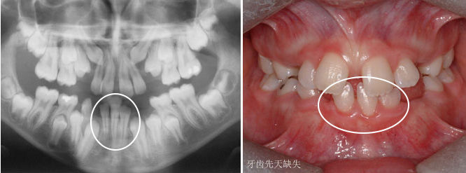 小孩换牙新牙迟迟长不出怎么办,换牙后门牙旁边两颗牙迟迟不长