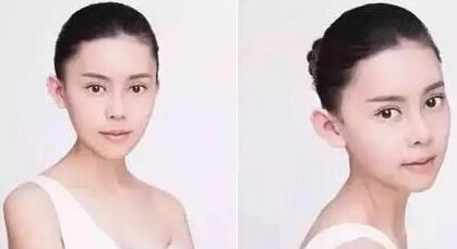 重庆女孩自曝整容日记，迷教主花百万变形为Angelababy
