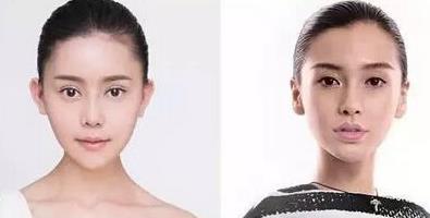 重庆女孩自曝整容日记，迷教主花百万变形为Angelababy