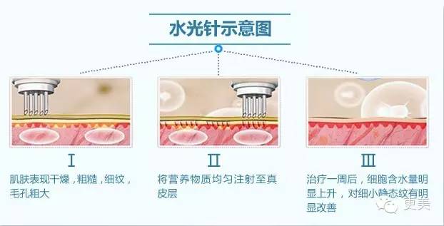 瘦脸针只打一针管用吗,瘦脸针只瘦咬肌吗