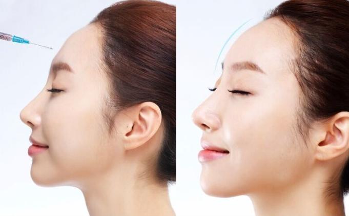 微整是怎么做到无痕的,微整怎么辨别