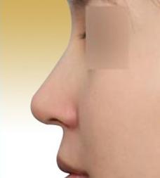 微整是怎么做到无痕的,微整怎么辨别