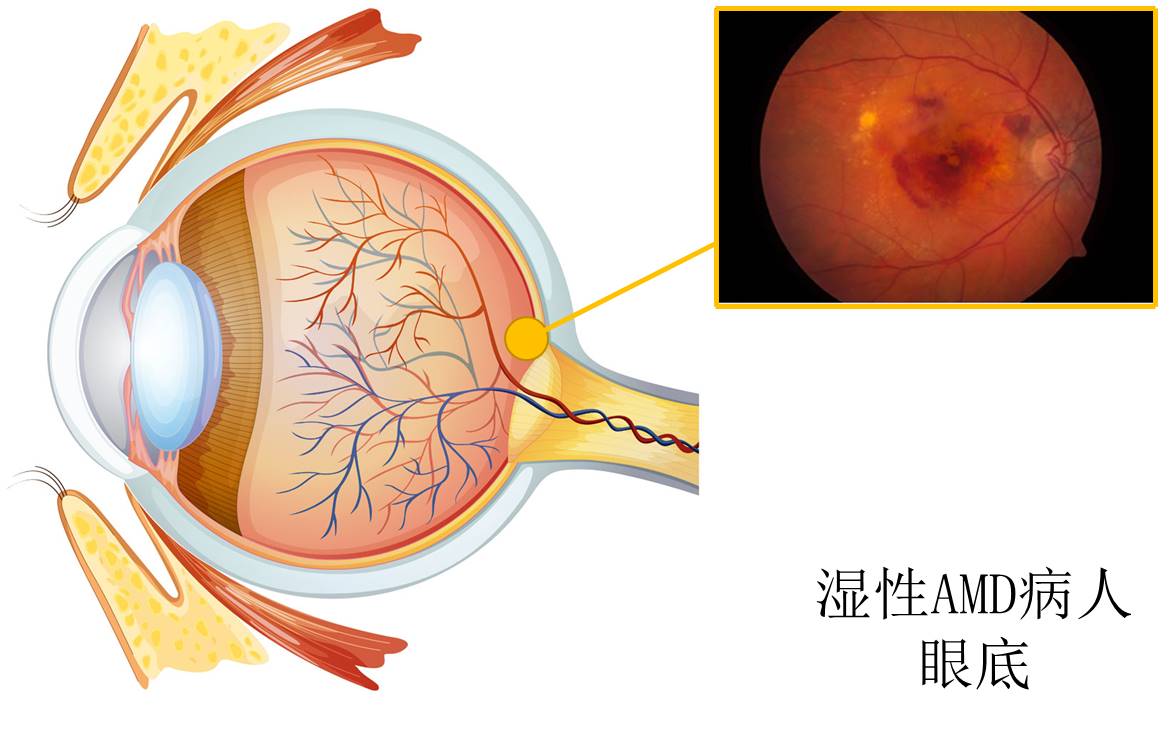 得了黄斑病变还能玩手机,得了黄斑病症状