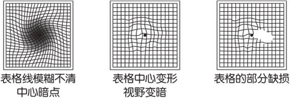 得了黄斑病变还能玩手机,得了黄斑病症状