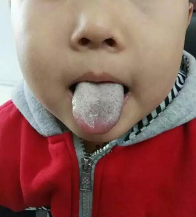 推拿小儿舌苔厚,小儿推拿舌苔知识