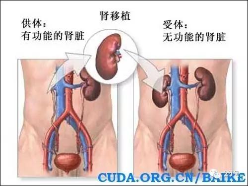 孩子慢性肾炎等待肾移植,郑大一附院肾移植全过程