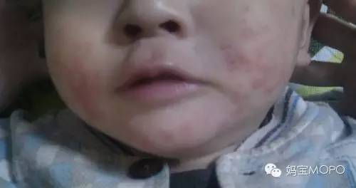 湿疹“大难题”,这些应对技巧请收好