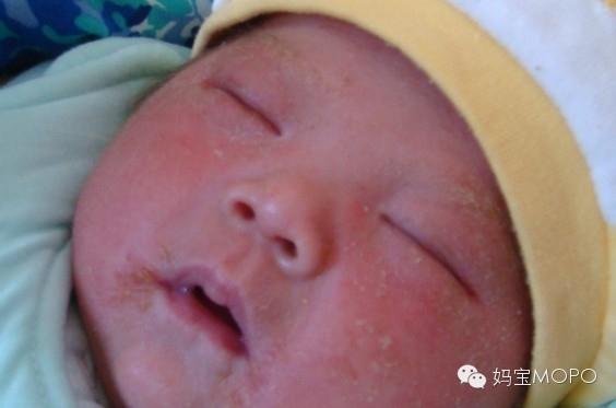 湿疹“大难题”,这些应对技巧请收好