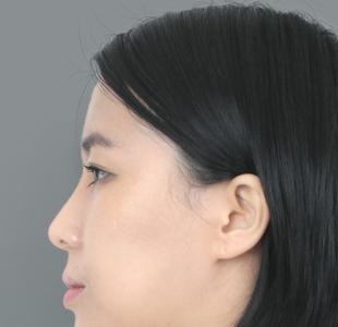 微整是怎么做到无痕的,微整怎么辨别