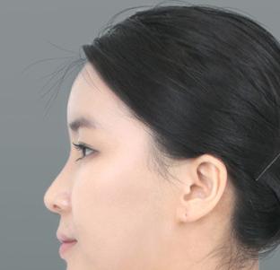 微整是怎么做到无痕的,微整怎么辨别