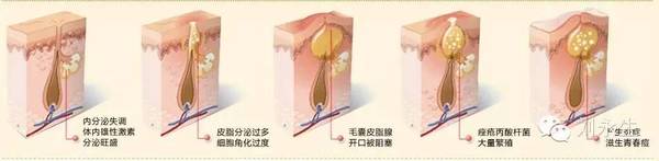 挤痘痘为什么会有生命危险,挤痘痘出现危险的几率