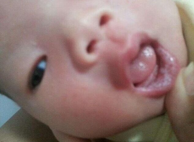 宝宝得了鹅口疮，博士级妈妈竟用外婆的偏方，差点要了孩子的命