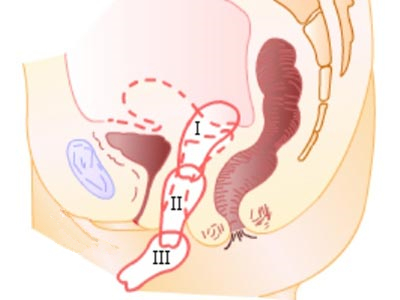 产后必读!常见病防治之子宫脱垂!