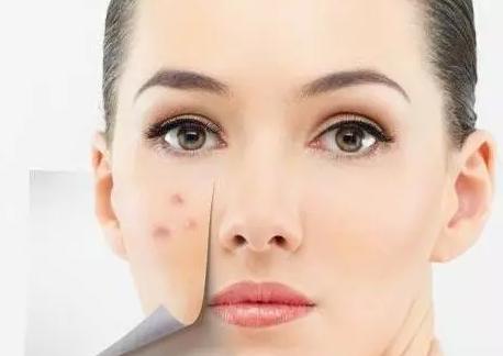 痘痘留下的坑印怎么办,脸上痘痘擦什么药膏不留印