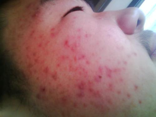 你真的了解痘痘吗,你是真的了解侘寂风吗