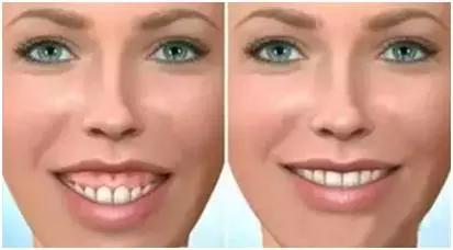 牙周病的治疗过程,牙周病的治疗全过程