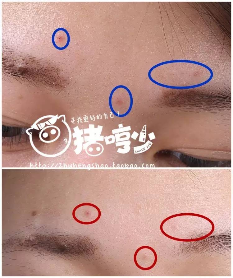 黑头难去怎么办,黑头怎么才能永远消失