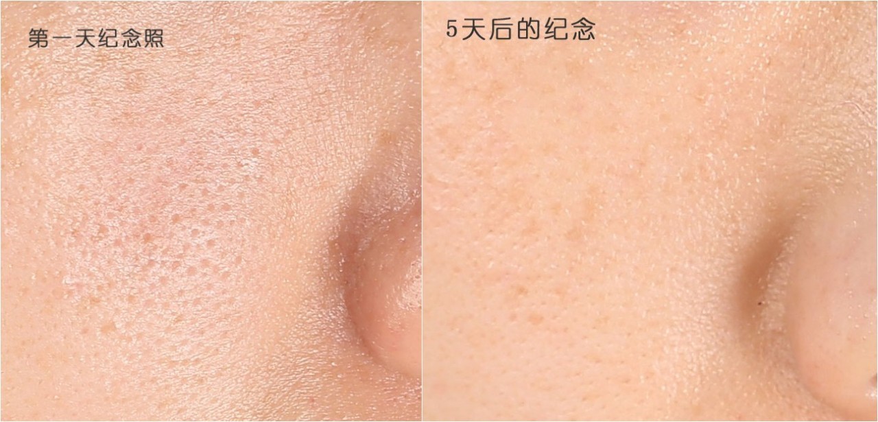 黑头难去怎么办,黑头怎么才能永远消失