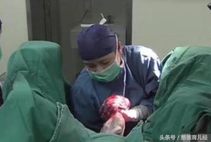 顺产的宝妈都知道要备皮，可是剖腹产也需要备皮吗？