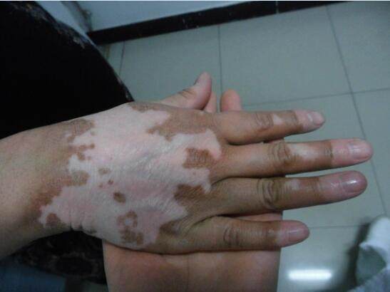 肢端型白癜风的病情是怎样的,肢端型白癜风怎么治疗