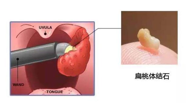 从小到大口臭的厉害,从小到大口臭特别重