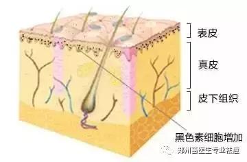 真皮斑会癌变吗,黄褐斑到底是真皮斑还是表皮斑
