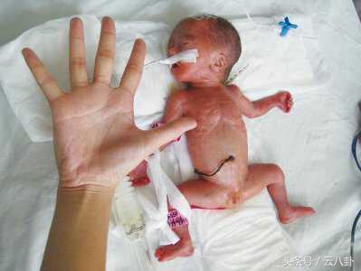 孕妇本以为小小的阴道炎没事竟是胎儿的天敌,害早产宝宝成这样