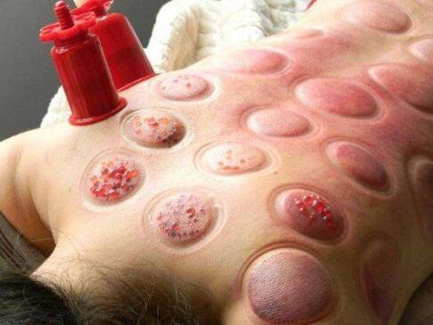 拔火罐能祛湿体内的湿气吗,祛除湿气拔火罐方法