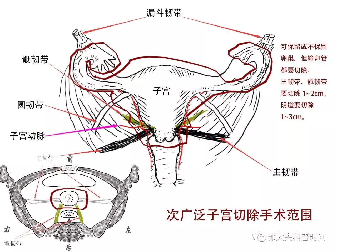 关于子宫切除的小秘密（一）——切除范围