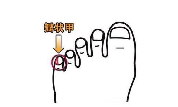 小脚趾头指甲分两瓣,如果你的小脚趾有两瓣趾甲